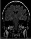 FLAIR Axi T2 DWI SWI Newly discovered tumor Tumor follow-up Tumor patient with Dizziness Headache