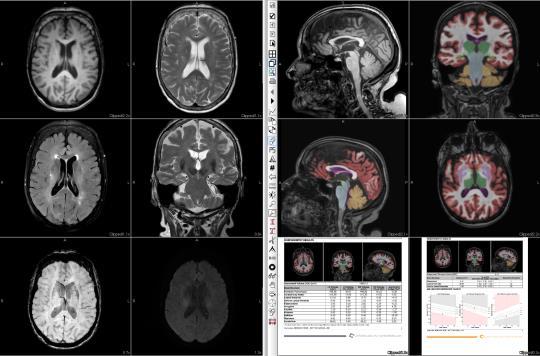 SWI Seizure Cor T2 Head trauma Dizziness / vertigo as leading symptoms Cranial nerves: 3, 5, 6, 7&8, 9