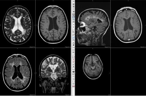 FLAIR and IR Hippocampal sclerosis GM abnormalities Aligned with hippocampus Gadolinium contrast is not
