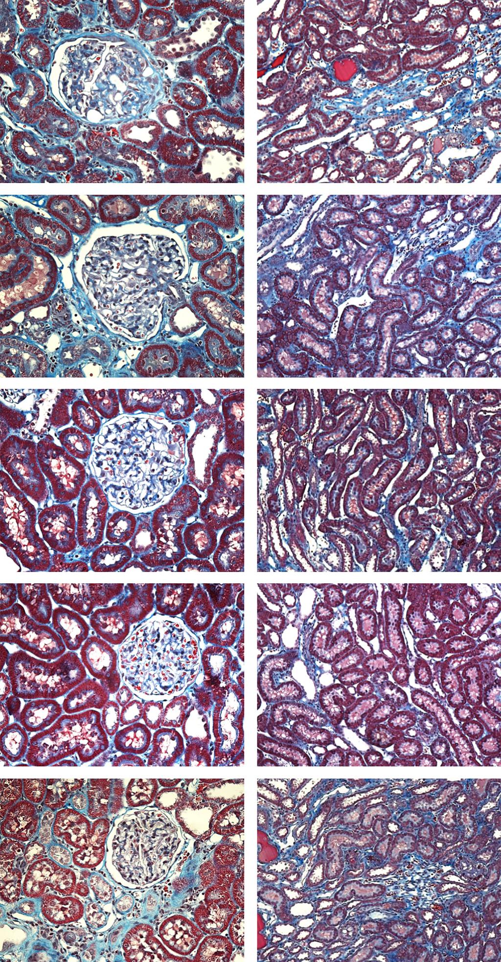 Renoprotective Effects of SGLT2 Inhibition Cortex Medulla Vehicle μm μm Luseogliflozin Lisinopril Combination Insulin Figure 6.