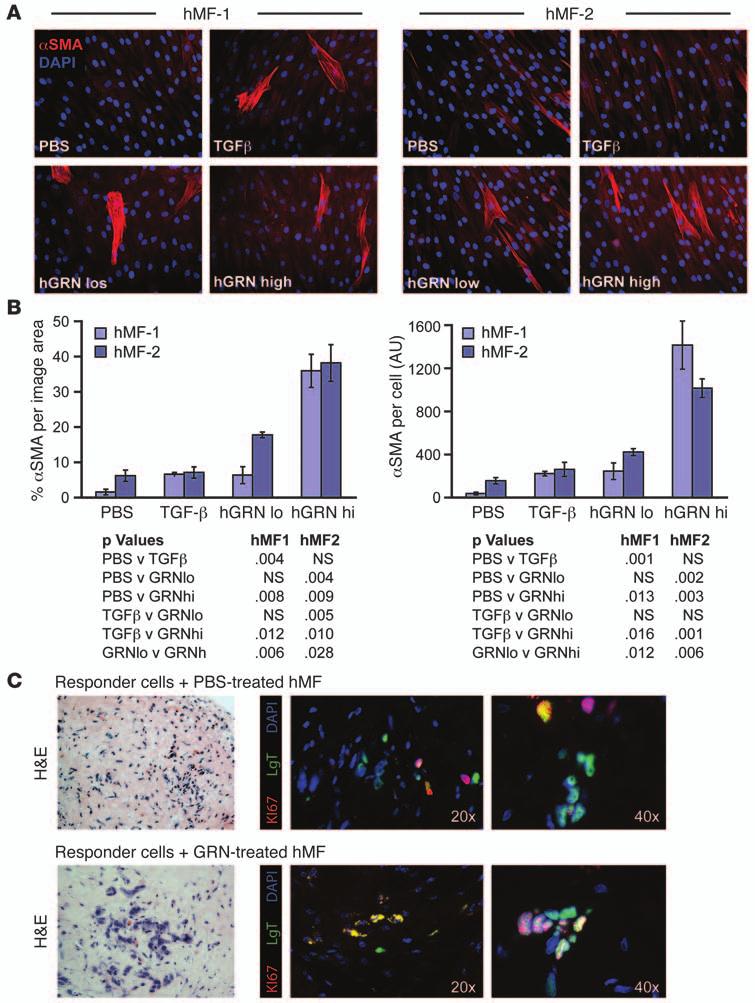Figure 6 GRN induces αsma expression in human mammary fibroblasts and affects tumor growth.