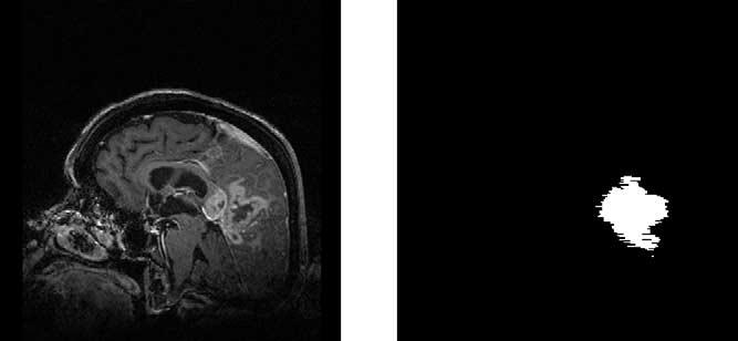 PRASTAWA ET AL Academic Radiology, Vol 10, No 12, December 2003 Figure 1. Gadolinium contrast enhanced T1-weighted MR image (sagittal view) and the manual tumor segmentation result.