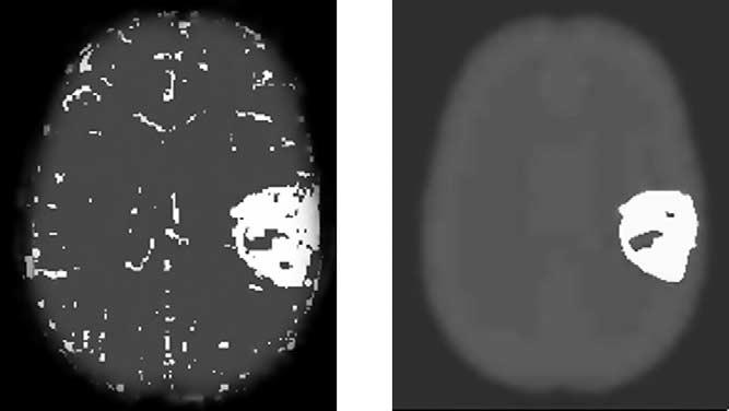 PRASTAWA ET AL Academic Radiology, Vol 10, No 12, December 2003 Figure 4. (Left) The T1 postcontrast and precontrast difference image histogram and the fitted model.