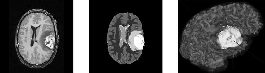 PRASTAWA ET AL Academic Radiology, Vol 10, No 12, December 2003 Figure 9. Automatic segmentation result for the Tumor020 data. (Left) T1 postcontrast image (for reference).