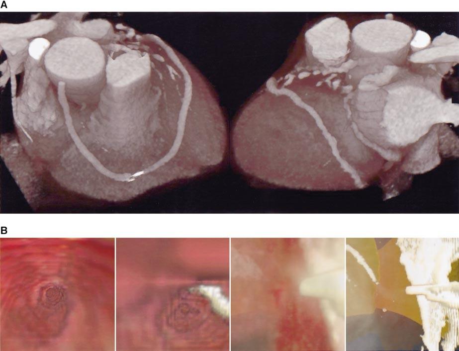 van Ooijen et al Coronary Artery Fly-Through 3 Figure 2. A, Volume renderings of a patient with a coronary artery bypass graft.