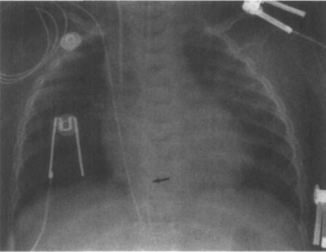The positive grounding lead was attached to a regular ECG monitoring elecurode. Black arrow shows an Arrow-Johns ECG Adapter connected to snap-lock connector of the epidural catheter.