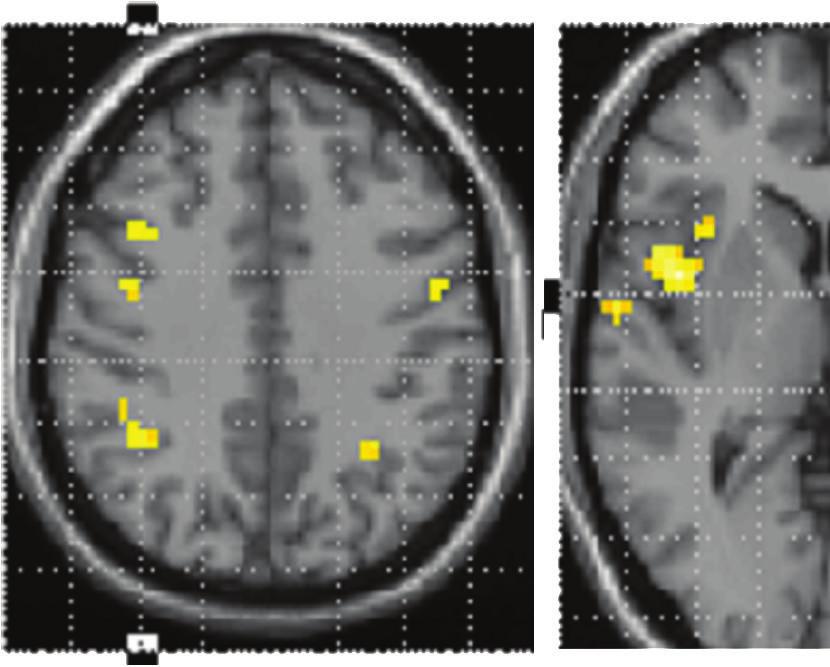 ISRN Neurology z = 39 mm 7 z = 3 mm z = 60 mm z = 57 mm (a) z = 39 mm z = 12 mm (b) z = 54 mm z = 9 mm z = 60 mm (c) Figure 2: Statistical parametric maps of brain activity of different comparisons: