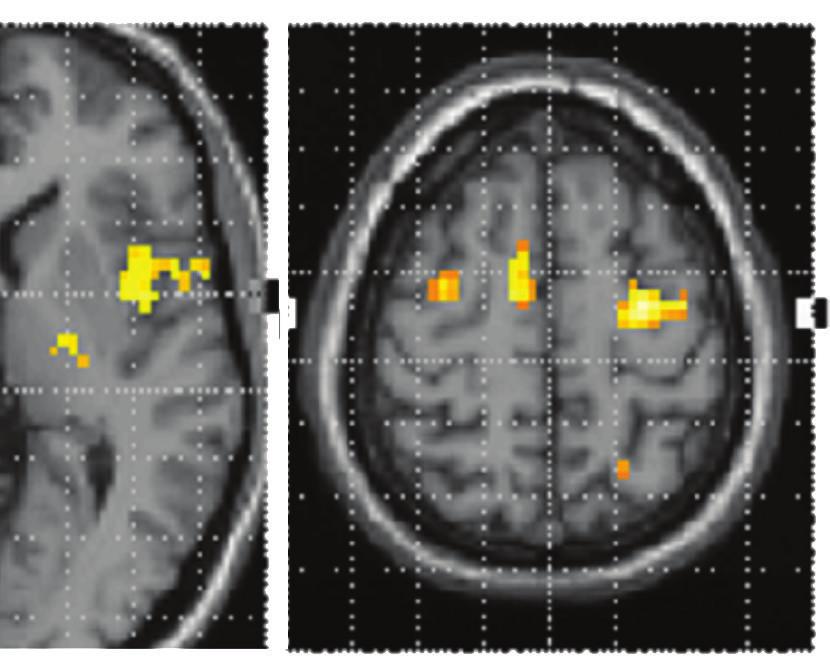 (a) Statistical parametric maps of brain activity Imagery of the affected hand > rest. Activations detected during imagined movement of the affected hand.