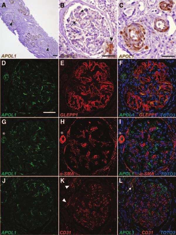 CLINICAL RESEARCH Figure 3. Altered renal localization of APOL1 in focal segmental glomerulosclerosis (FSGS).