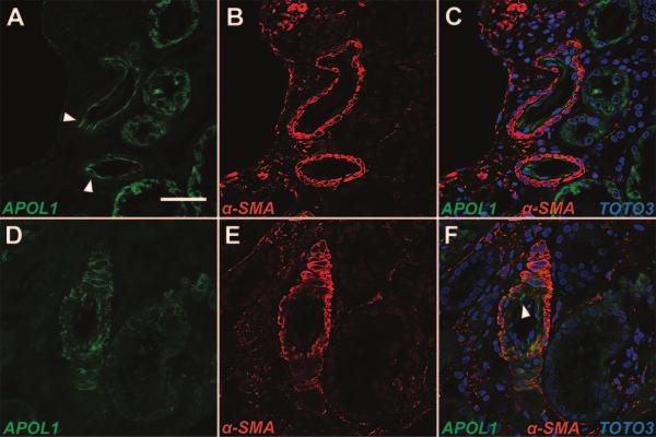 Figure 4. De novo localization of APOL1 to the renal arterial wall in FSGS. Confocal immunofluorescence imaging of medium sized renal arterioles from the normal human kidney (A C) and from FSGS (D F).