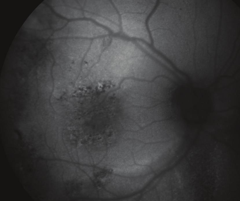 Case Reports in Ophthalmological Medicine 3 Figure 3: Fundus autofluorescence image taken 2 days after treatment.