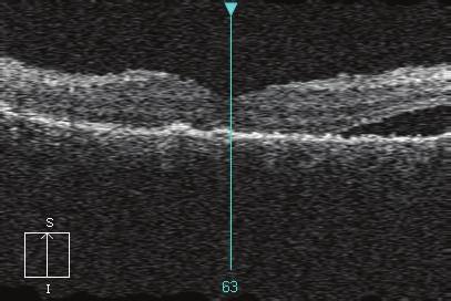 On the midperiphery, older retinal changes can be seen, due to previous serous fluid accumulation. Figure 4: OCT scan a month after SDM treatment.
