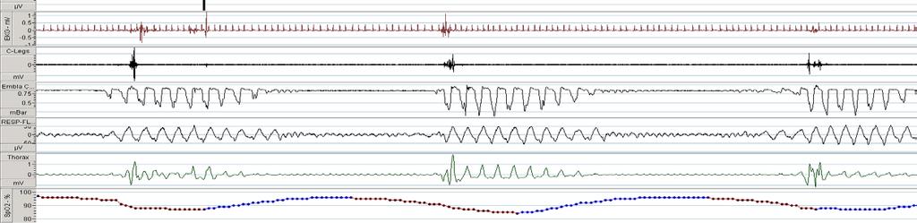 Case Section IIII A limited channel sleep study was available to the unit.
