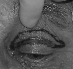 Regional nerve block of the upper eyelid in oculoplastic surgery S u p r a o r b i t a l L a c r i m a l S u p r at r o c h l e a r I n f r at r o c h l e a r Z y g o m at i c o f a c i a l I n f r a