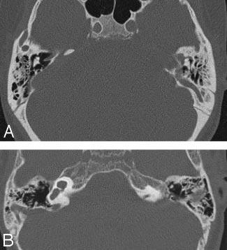 Imaging findings of the ears with labyrinthine aplasia Patient CT/MRI CLA Otic Capsule Middle Ear Ossicle Anomaly IAC Cochlear Nerve Facial Nerve Course Jugular Anomaly Posterior Fossa Anomaly Skull