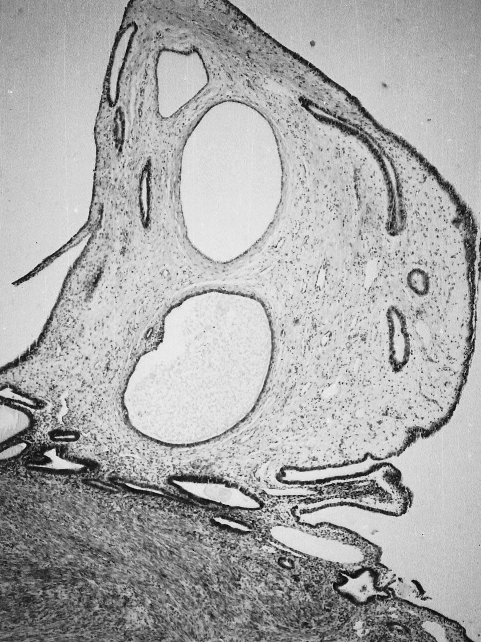 FIGURE 3. Endometrial polyp in hysterectomy specimen.