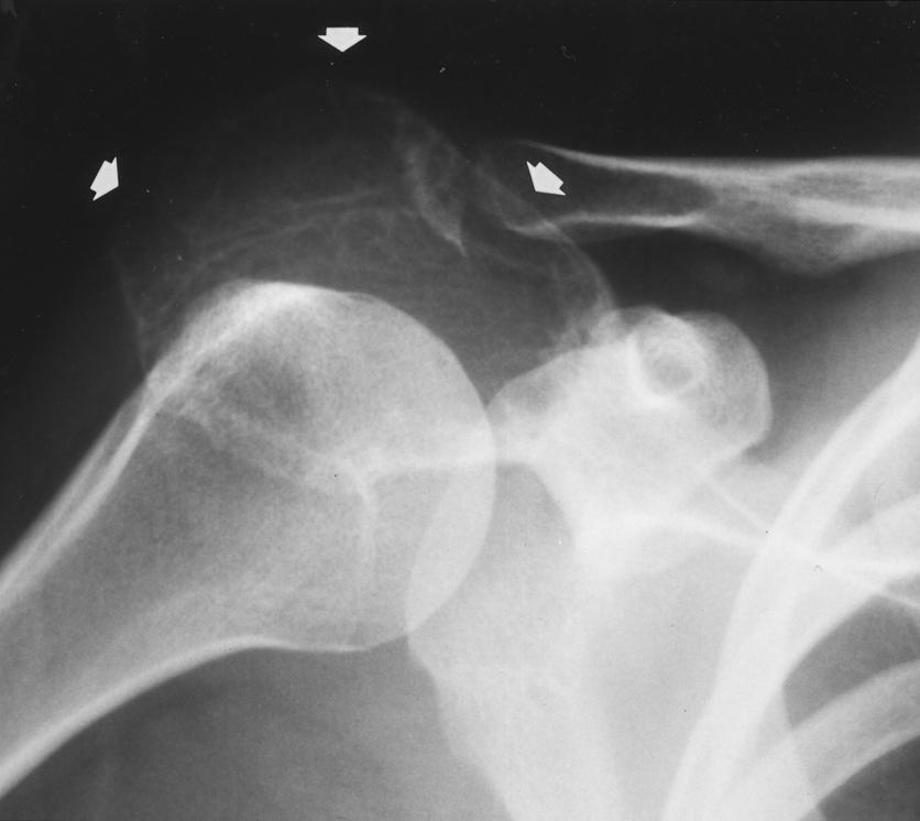 , Frontal radiograph shows large expansile lesion (arrows) in acromion.