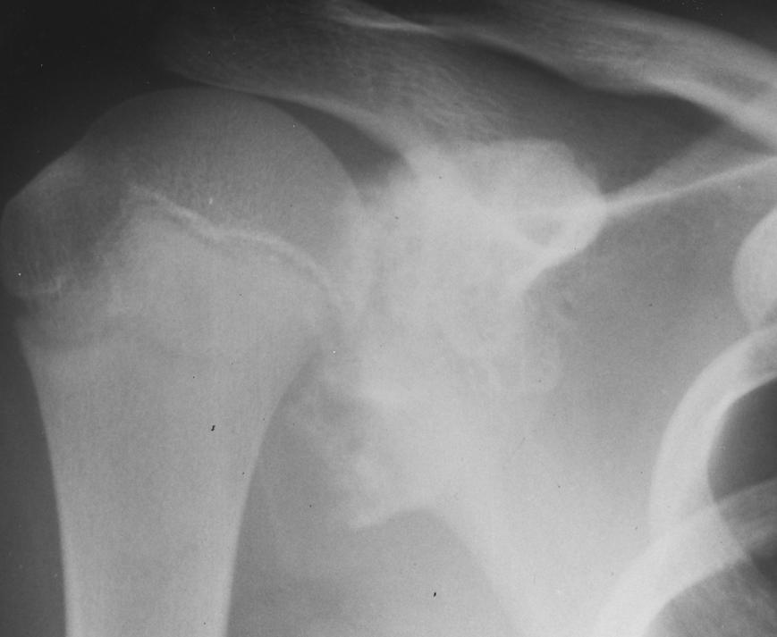 14-year-old boy with chondrosarcoma in preexisting osteochondroma.