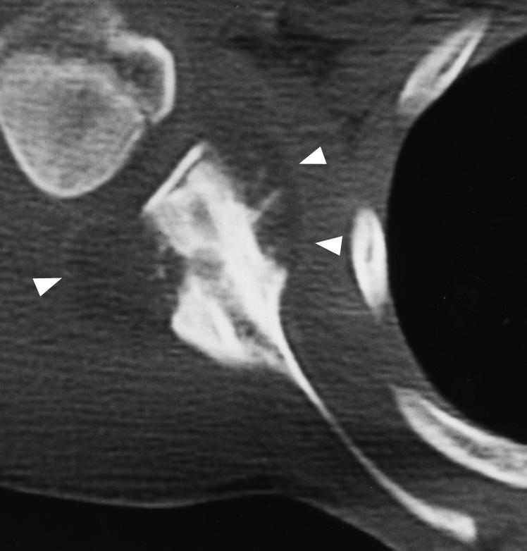rim., xial T scan obtained at same time as shows osteochondroma and