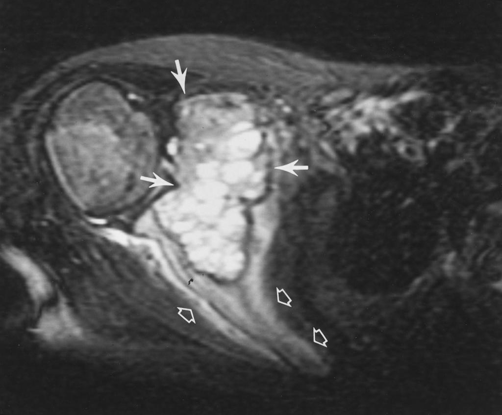 expansile lesion (solid arrows) with rim of high-signal-intensity edema (open