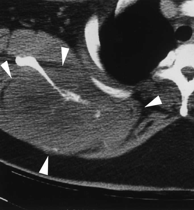 E, Frontal radiograph of unconstrained total scapular prosthesis with cemented