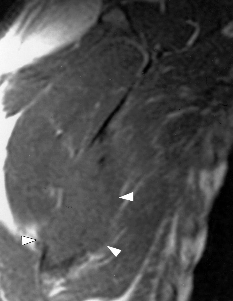 , Frontal radiograph shows lytic lesion (arrowhead) in body of scapula.