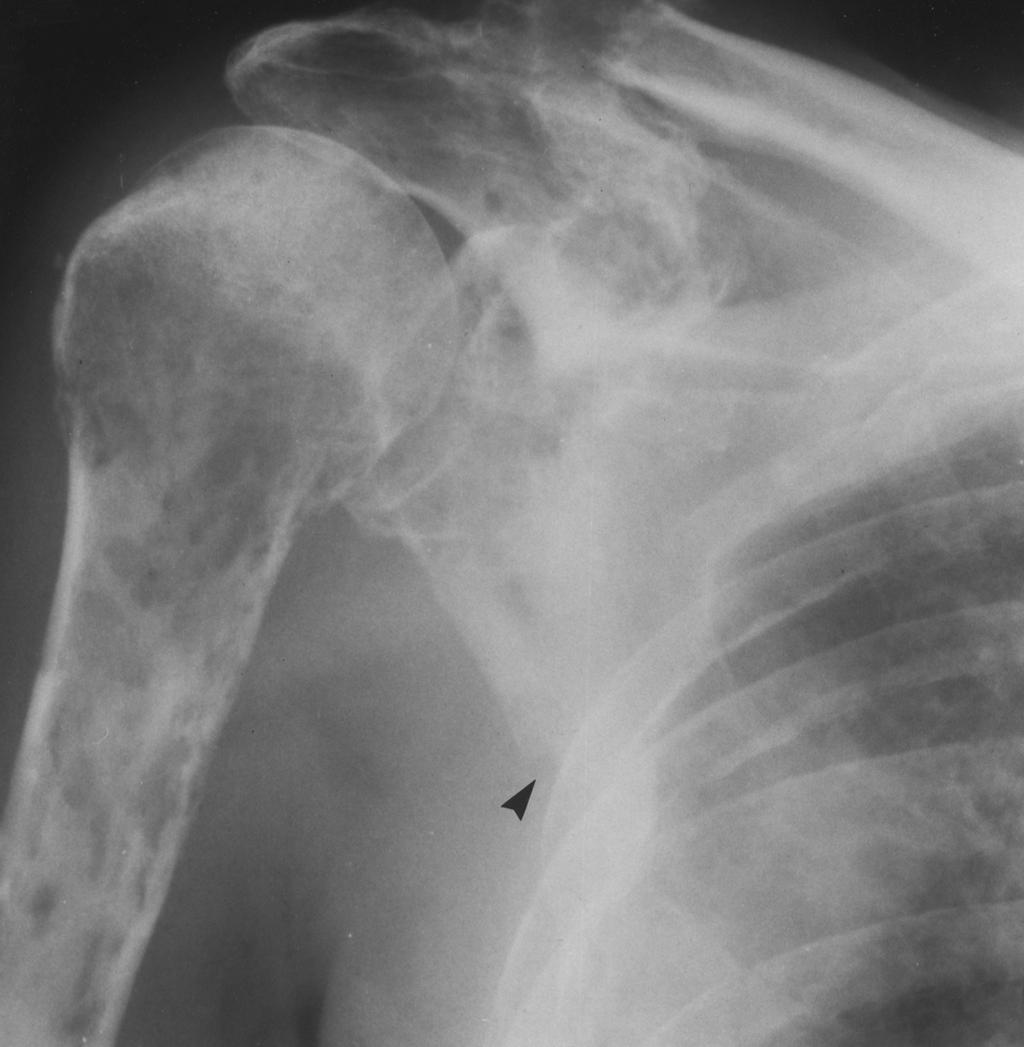 , Frontal radiograph of 80-year-old man with honeycomb appearance of multiple myeloma in humerus, acromion, and ribs shows discrete punched-out lesion in