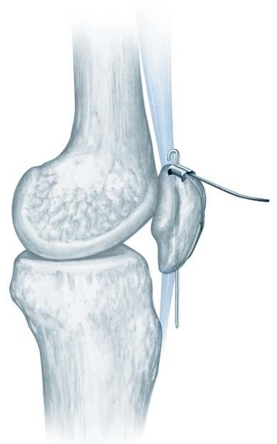 3 Create the tension band Place the crimp on the lateral or medial side of either pole of the patella. Pass a 1.