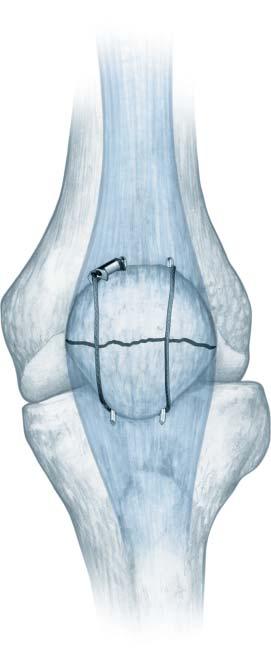 patella in a figure-of-eight and back through the open hole in the crimp. over UNDER TENSION BAND PATELLA Pass a 1.