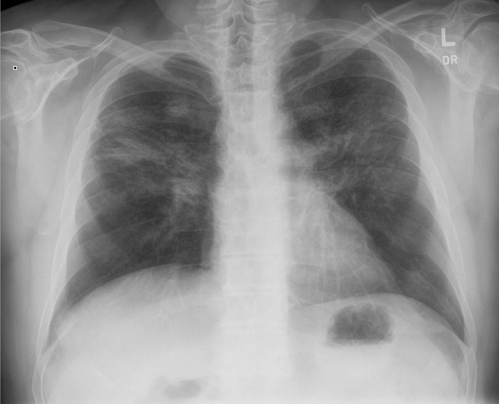 Upper-to-mid lung zone scarring with some