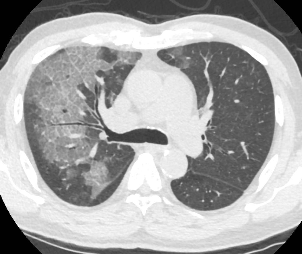 bronchiectasis Scattered centrilobular lucencies suggesting early