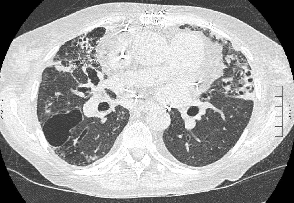 S/P Lung transplant Lung parenchymal abnormalities with multiple air cysts, bronchial thickening, bronchiectasis and nodular opacities Right apical pleural thickening and air cyst