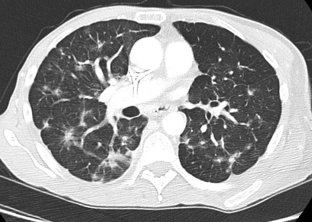 History of lung cancer, shortness of breath Worsening metastatic disease burden in the lung parenchyma with worsening nodular opacities in
