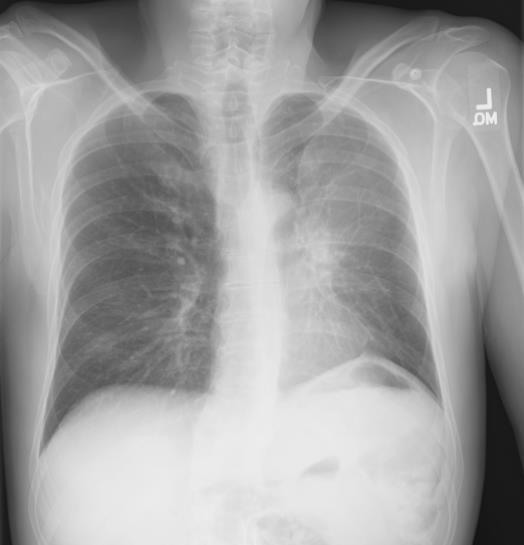 55M smoker presented with shortness of breath Hazy opacity overlying the left hemithorax with increased opacity in the left lung hilum