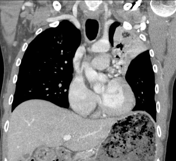 Collapse of left upper lobe with possible
