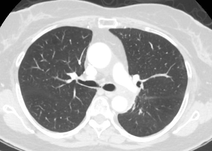 descending pulmonary, and descending aorta and exhibits mass effect on the ventral
