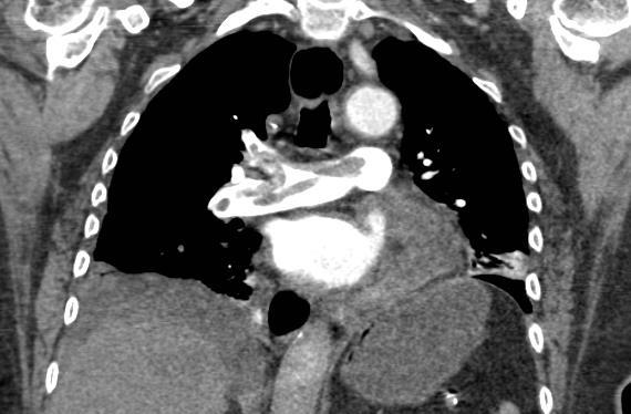 78F with CAD s/p CABG with acute hypoxia and chest pain Saddle embolism extending to