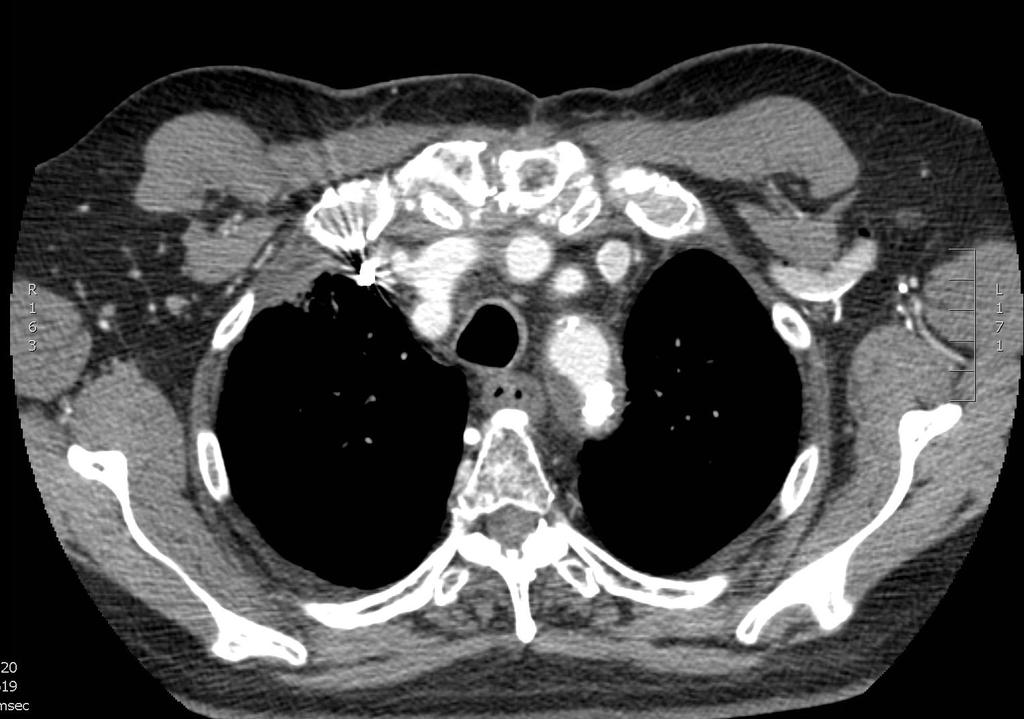 H/o thymoma Right upper lobe segmental two subsegmental pulmonary emboli as well is right lower lobe subsegmental pulmonary emboli