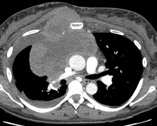 mediastinal mass with invasion of the right chest wall and