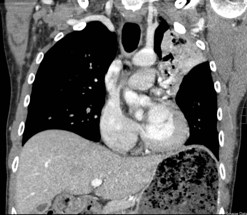 Collapse of left upper lobe with possible obstruction