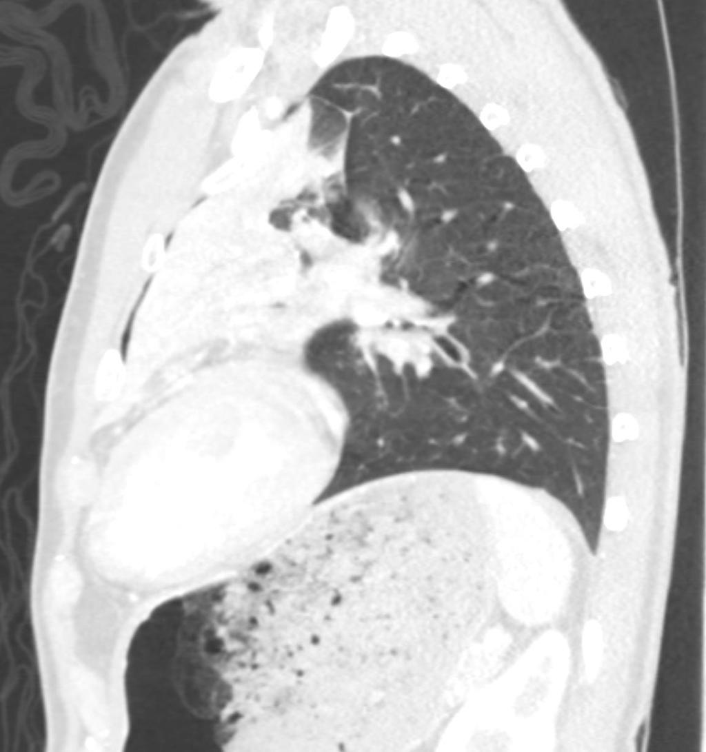 Scattered ground glass opacities in the right lung