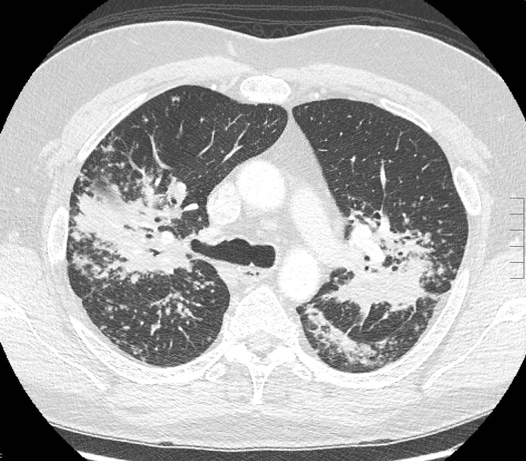 Subcm mediastinal and hilar/peribronchial lymph nodes Multiple bilateral subcm nodules and