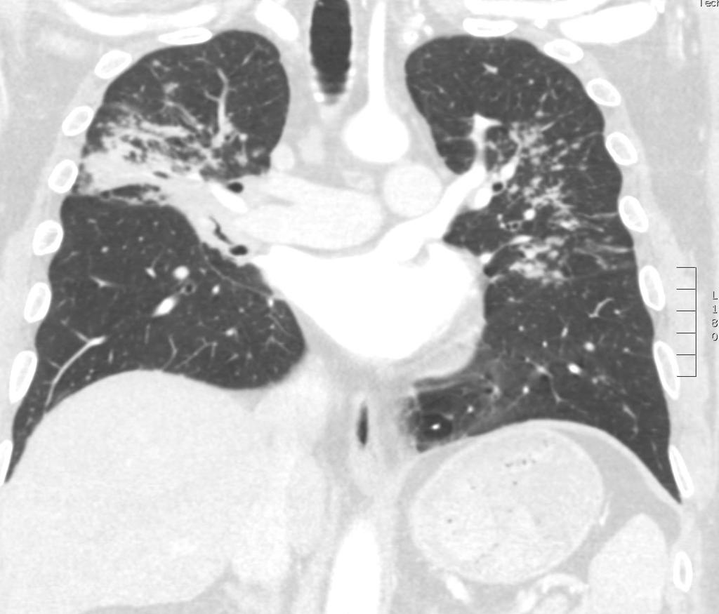 distribution, with bilateral mass-like consolidation Extensive bilateral lung findings