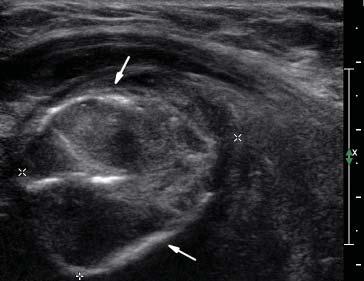 Microcarcinomas were 10 mm in maximum diameter and macrocarcinomas were >10 mm in maximum diameter. Fig. 1. A thyroid nodule ( papillary thyroid cancer ) with microcalcification (white arrow).