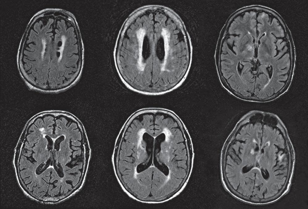 A C E B D F Figure 1. Magnetic resonance imaging (MRI) findings of patients with celiac disease and cognitive impairment; fluid-attenuated inversion recovery images are shown.