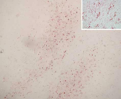 schowsky silver stain,, neurofilament, -synuclein, and prion immunohistochemistry results were negative.