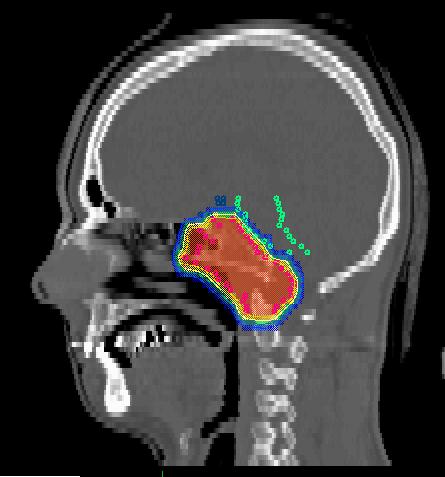 000 organ at risk tumor Locations: brain, base of the skull, prostate,