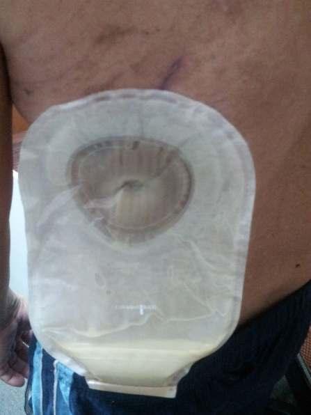 air tracks Figure 2: Colostomy bag (with
