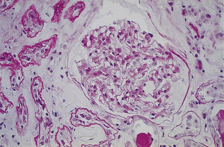Diffuse mesangial expansion, advanced arteriolar hyalinosis and mild interstitial fibrosis are present (PAS).