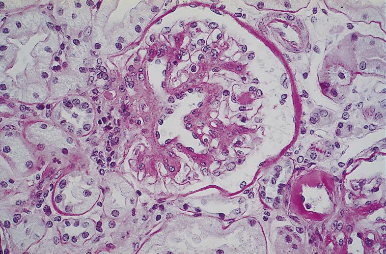 D Glomerulus from a patient in category C III (b), with mild mesangial expansion and severe arteriolar hyalinosis, affecting both afferent and efferent glomerular arterioles (PAS).